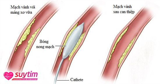 Mạch vành trước và sau khi nong mạch